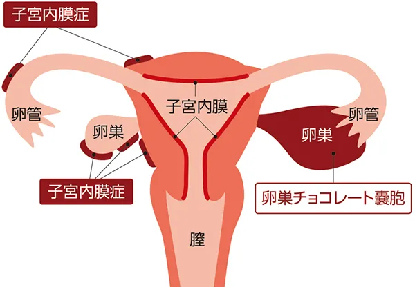 子宮内膜症、卵巣チョコレート嚢胞ができる箇所を示したイラスト。詳細は本文