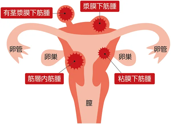 子宮筋腫ができる場所を示したイラスト。粘膜下筋腫は子宮の内側に、筋層内筋腫は子宮の筋肉の中に、漿膜下筋腫は子宮の外側にできる。漿膜下筋腫のうち、茎があるような状態で膨らんでいるものを有茎漿膜下筋腫という